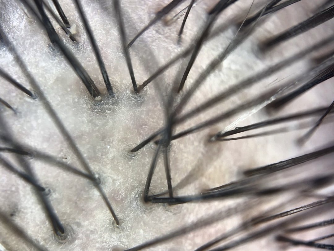 Healthy follicular grouping