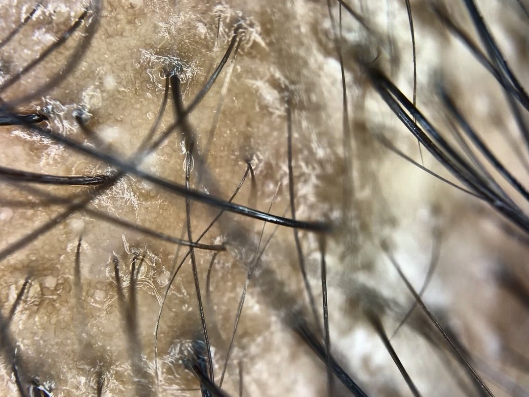 Hair-shaft thickness variation